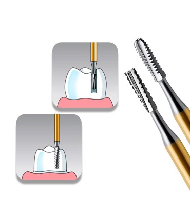 فرز کارباید کراون بر توربین - Dentalree